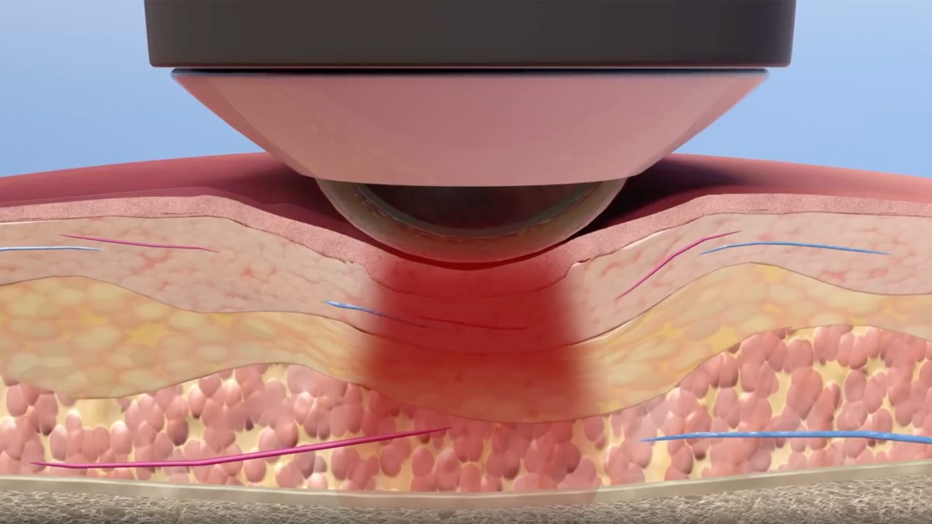 Laser Therapy Devices LightForce Therapy Lasers